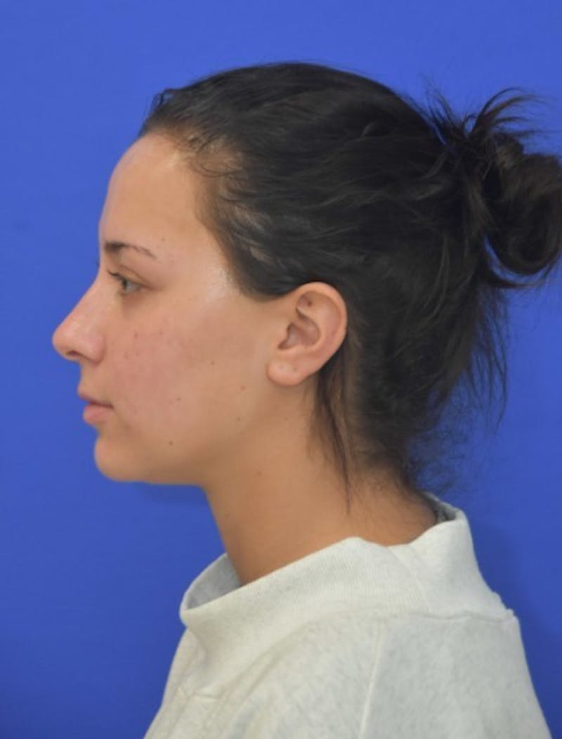 Neck Liposuction Before & After Gallery - Patient 549734 - Image 2