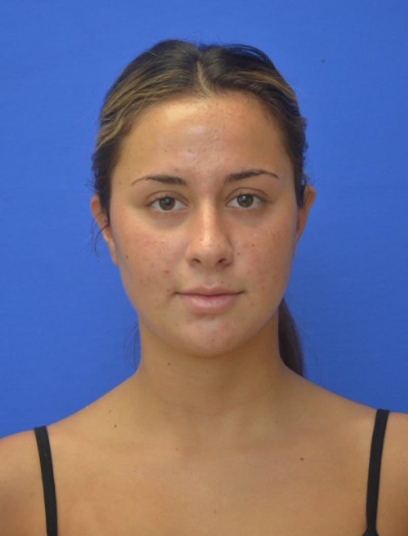 Neck Liposuction Before & After Gallery - Patient 549734 - Image 3