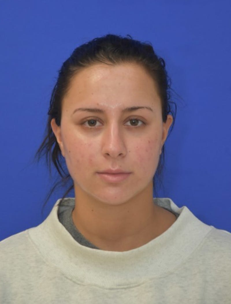 Neck Liposuction Before & After Gallery - Patient 549734 - Image 4