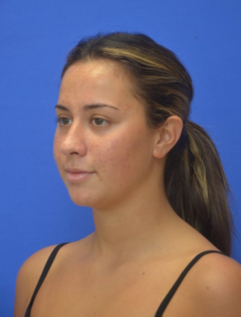 Neck Liposuction Before & After Gallery - Patient 549734 - Image 5