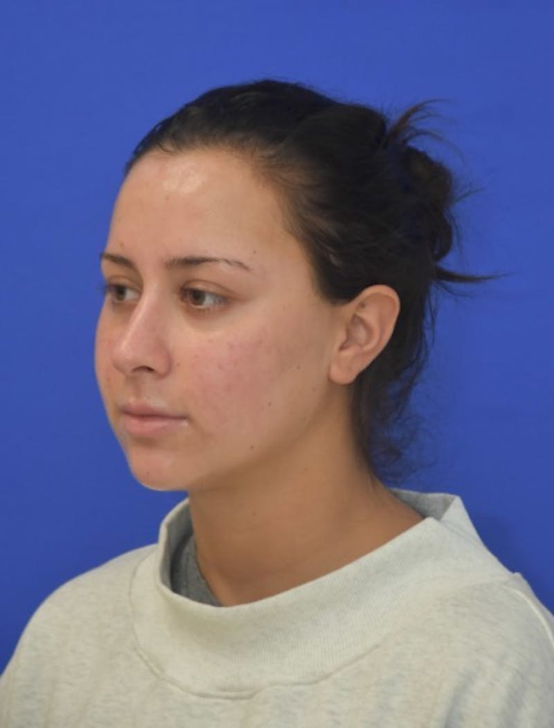 Neck Liposuction Before & After Gallery - Patient 549734 - Image 6