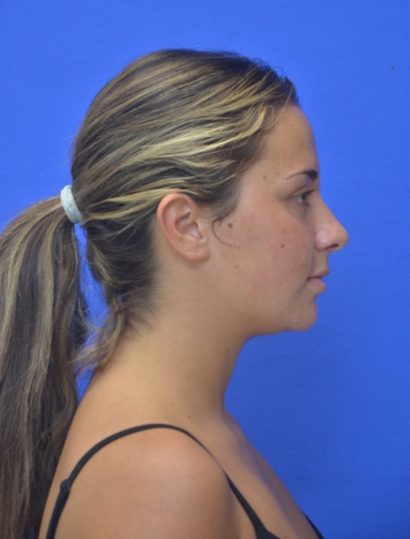 Neck Liposuction Before & After Gallery - Patient 549734 - Image 7