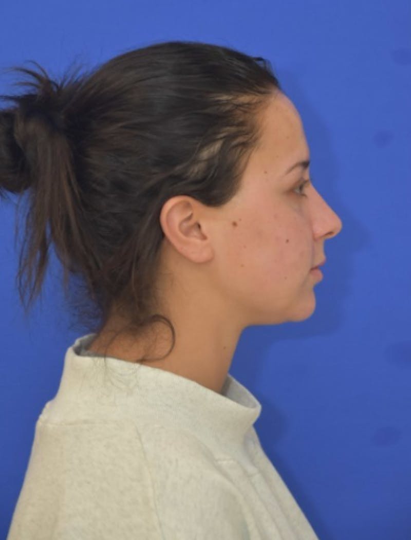 Neck Liposuction Before & After Gallery - Patient 549734 - Image 8