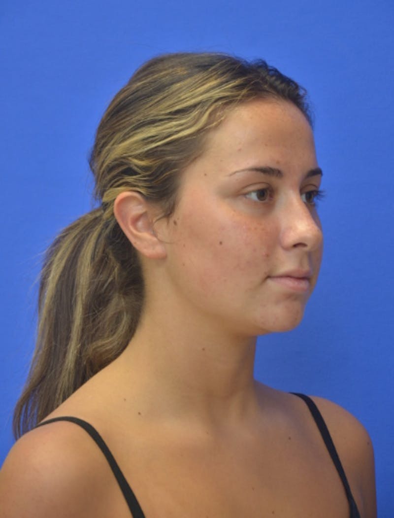 Neck Liposuction Before & After Gallery - Patient 549734 - Image 9