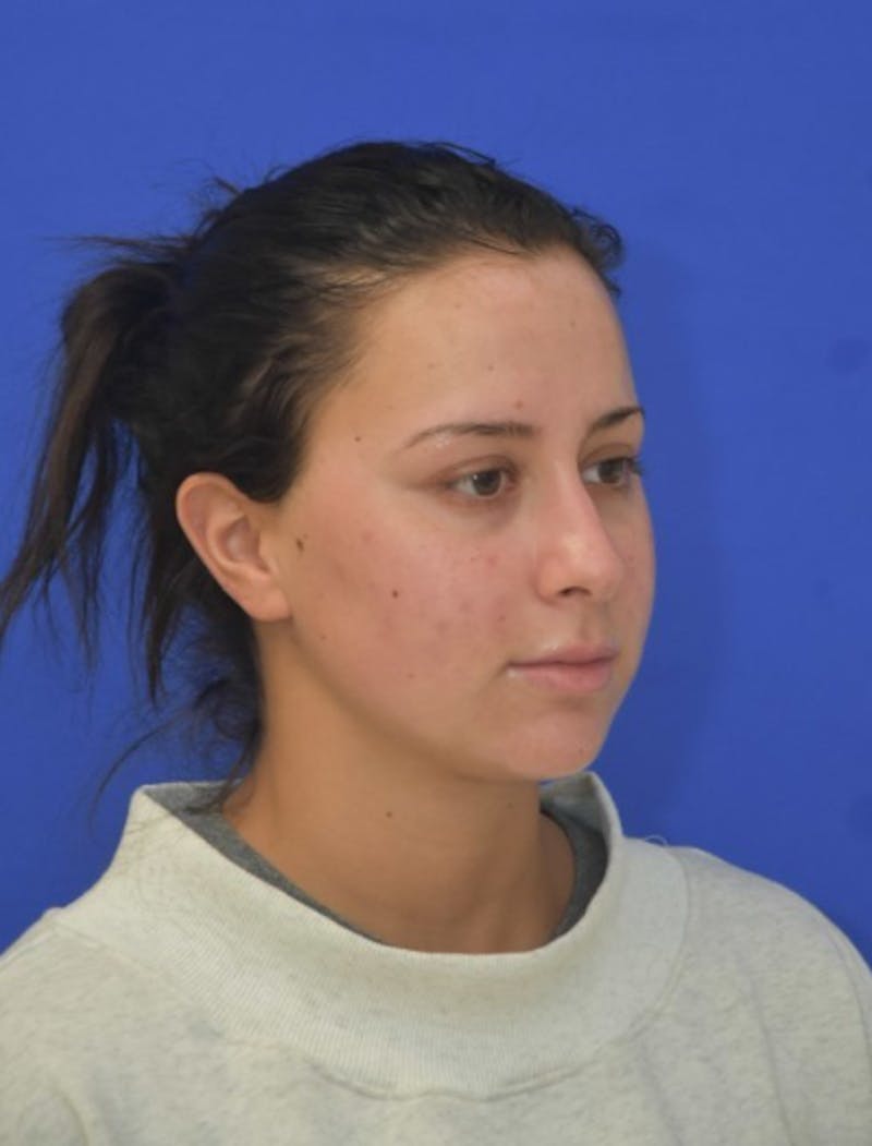 Neck Liposuction Before & After Gallery - Patient 549734 - Image 10