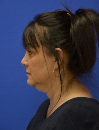 Neck Liposuction Before & After Gallery - Patient 225283 - Image 1