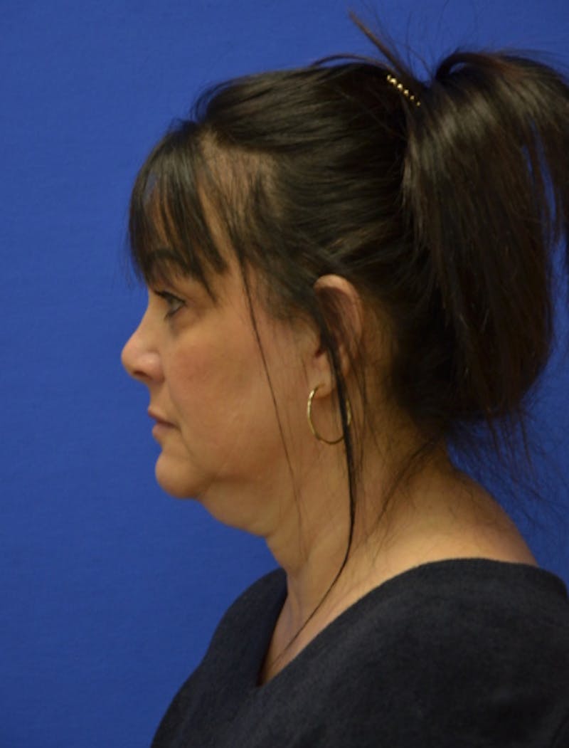 Neck Liposuction Before & After Gallery - Patient 225283 - Image 1
