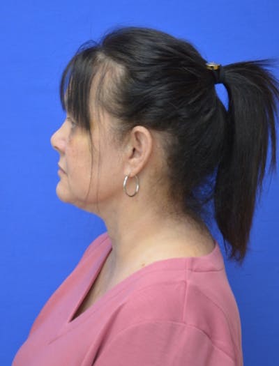 Neck Liposuction Before & After Gallery - Patient 225283 - Image 2