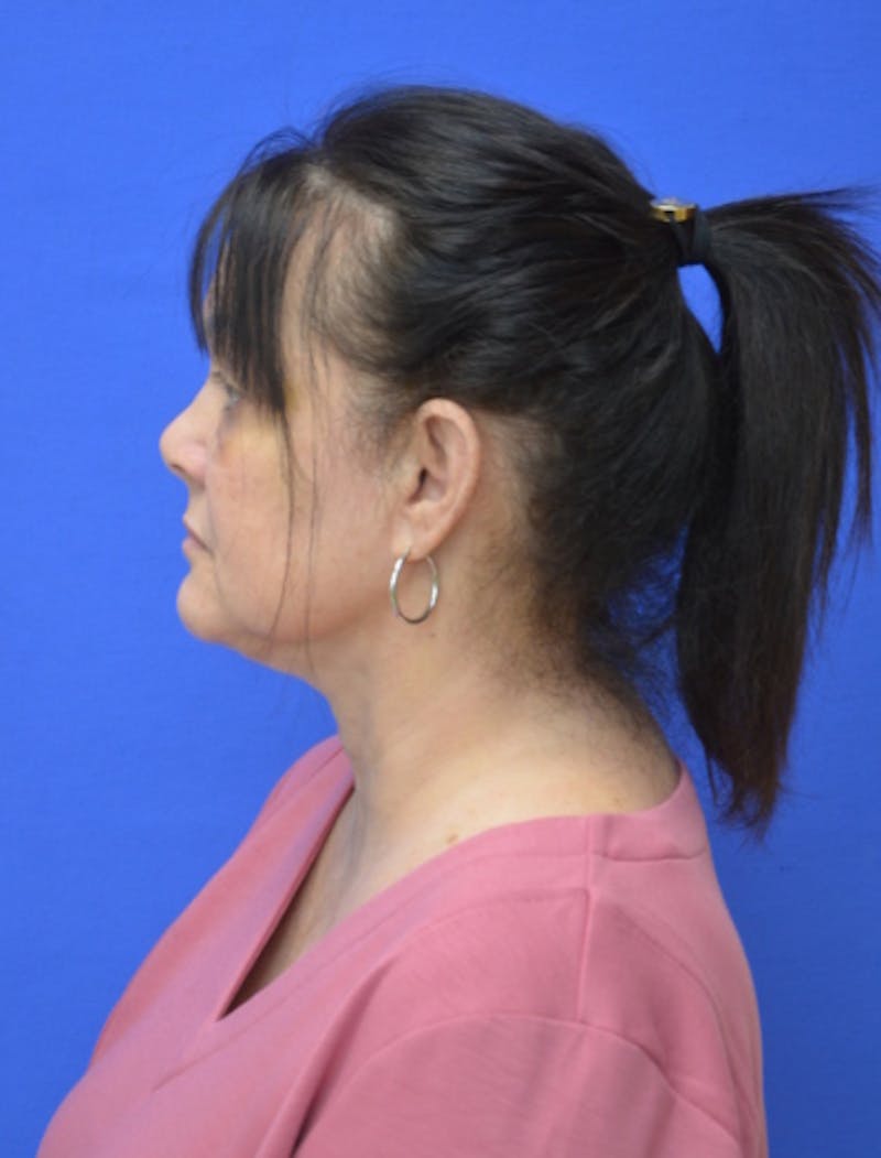 Neck Liposuction Before & After Gallery - Patient 225283 - Image 2