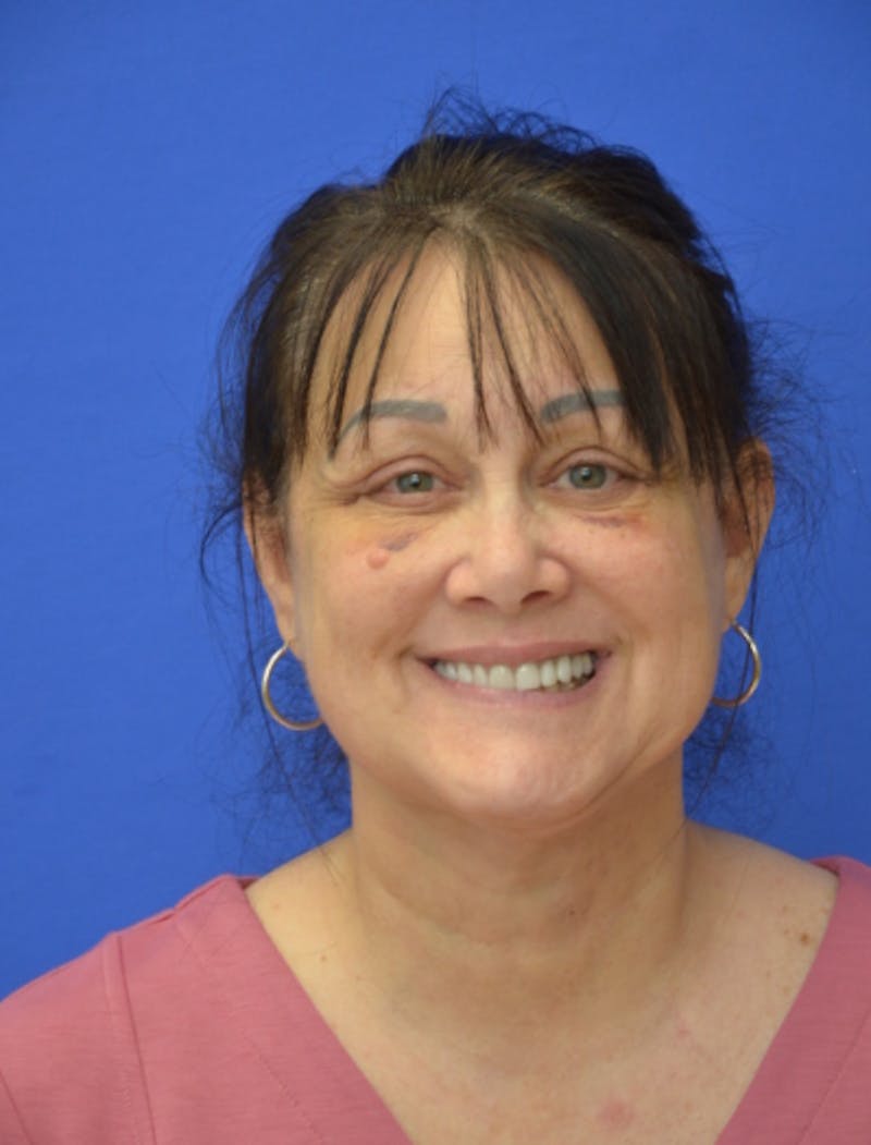 Neck Liposuction Before & After Gallery - Patient 225283 - Image 4