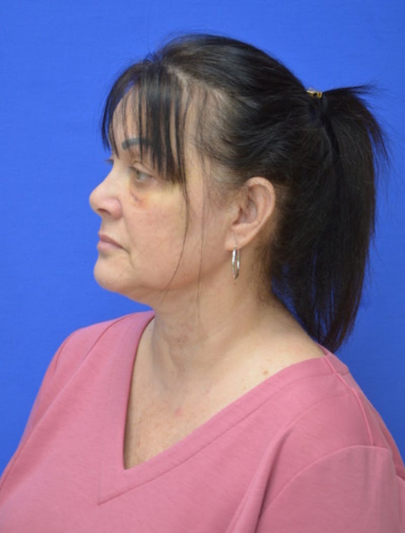 Neck Liposuction Before & After Gallery - Patient 225283 - Image 6