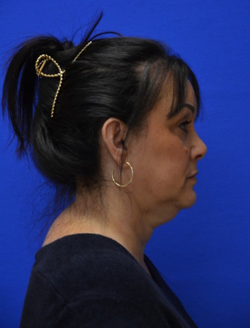 Neck Liposuction Before & After Gallery - Patient 225283 - Image 7