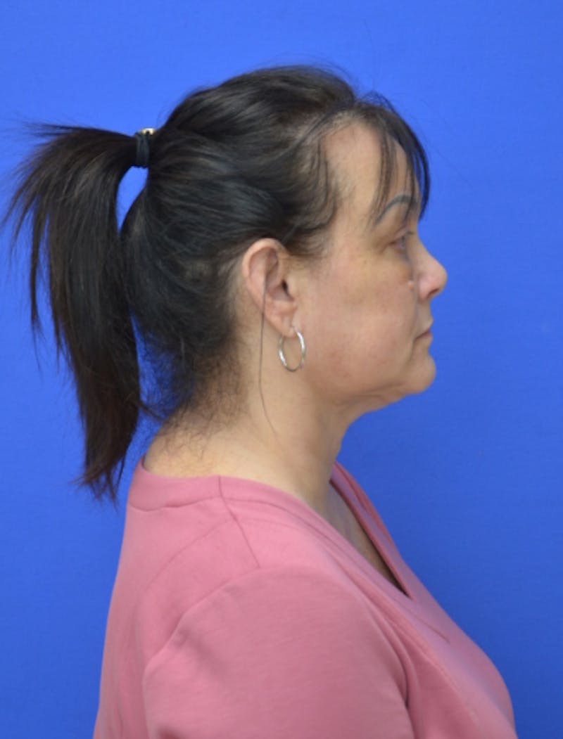 Neck Liposuction Before & After Gallery - Patient 225283 - Image 8