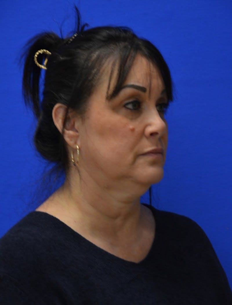 Neck Liposuction Before & After Gallery - Patient 225283 - Image 9