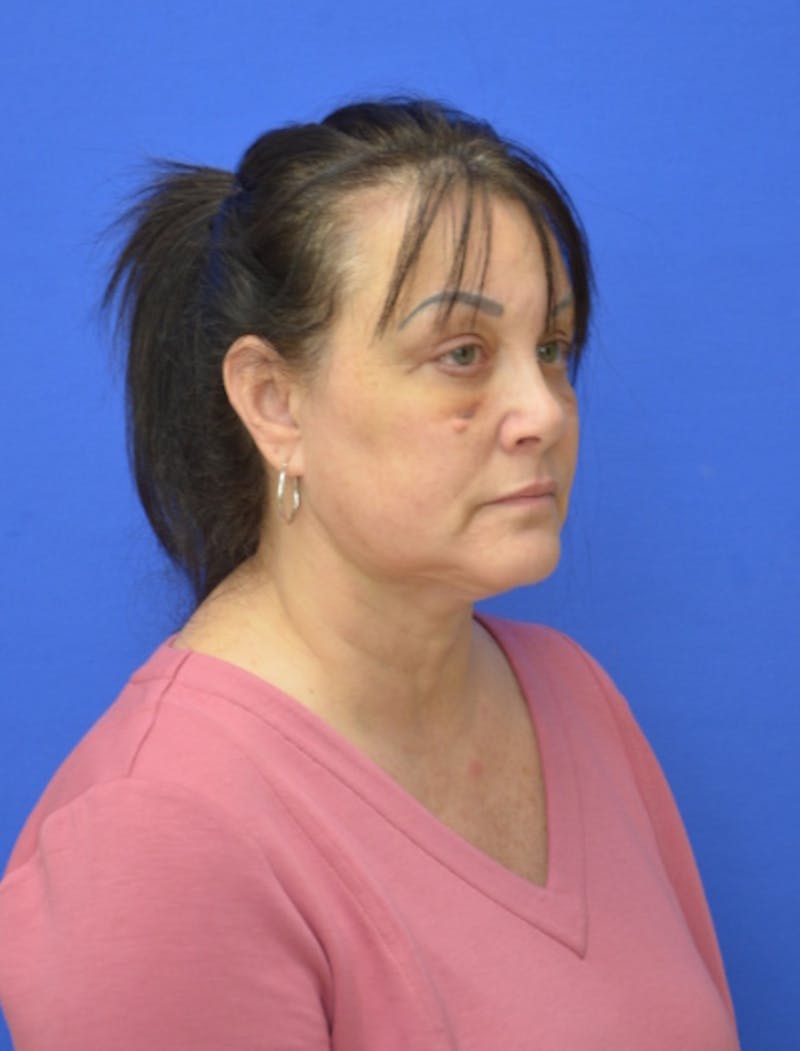 Neck Liposuction Before & After Gallery - Patient 225283 - Image 10