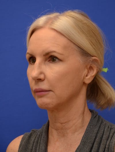 Neck Liposuction Before & After Gallery - Patient 418344 - Image 1