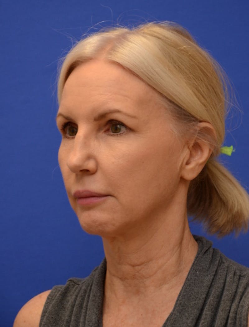 Neck Liposuction Before & After Gallery - Patient 418344 - Image 1