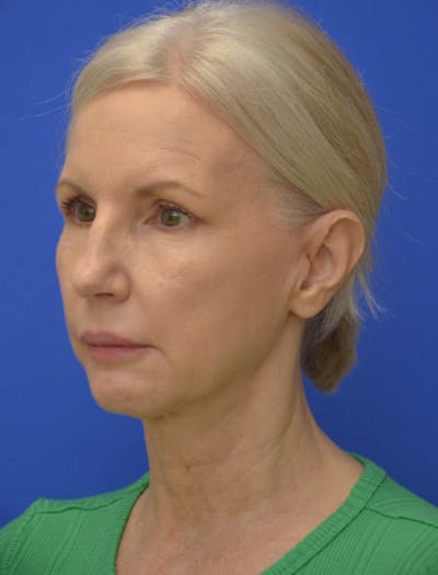 Neck Liposuction Before & After Gallery - Patient 418344 - Image 2