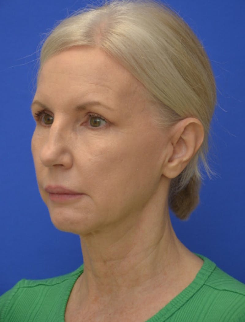 Neck Liposuction Before & After Gallery - Patient 418344 - Image 2