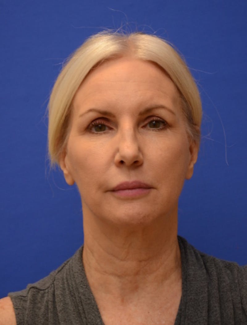 Neck Liposuction Before & After Gallery - Patient 418344 - Image 3