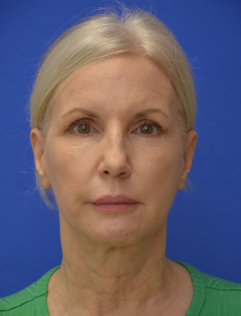 Neck Liposuction Before & After Gallery - Patient 418344 - Image 4