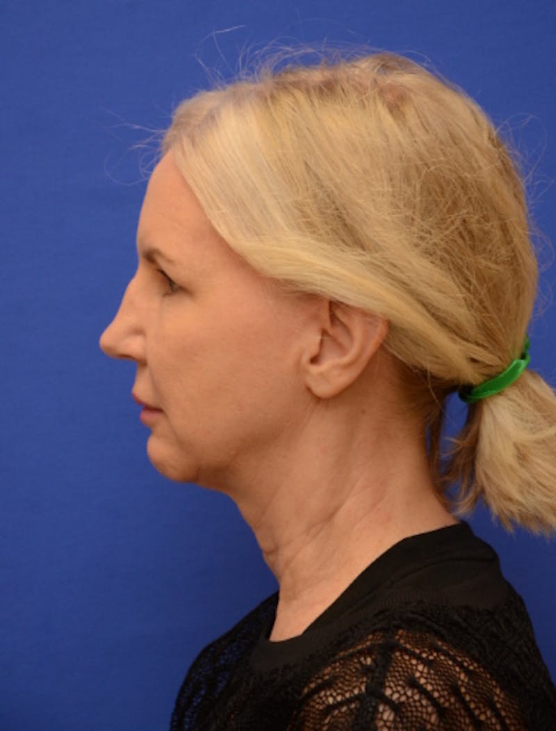 Neck Liposuction Before & After Gallery - Patient 418344 - Image 5