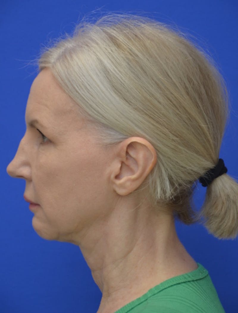 Neck Liposuction Before & After Gallery - Patient 418344 - Image 6