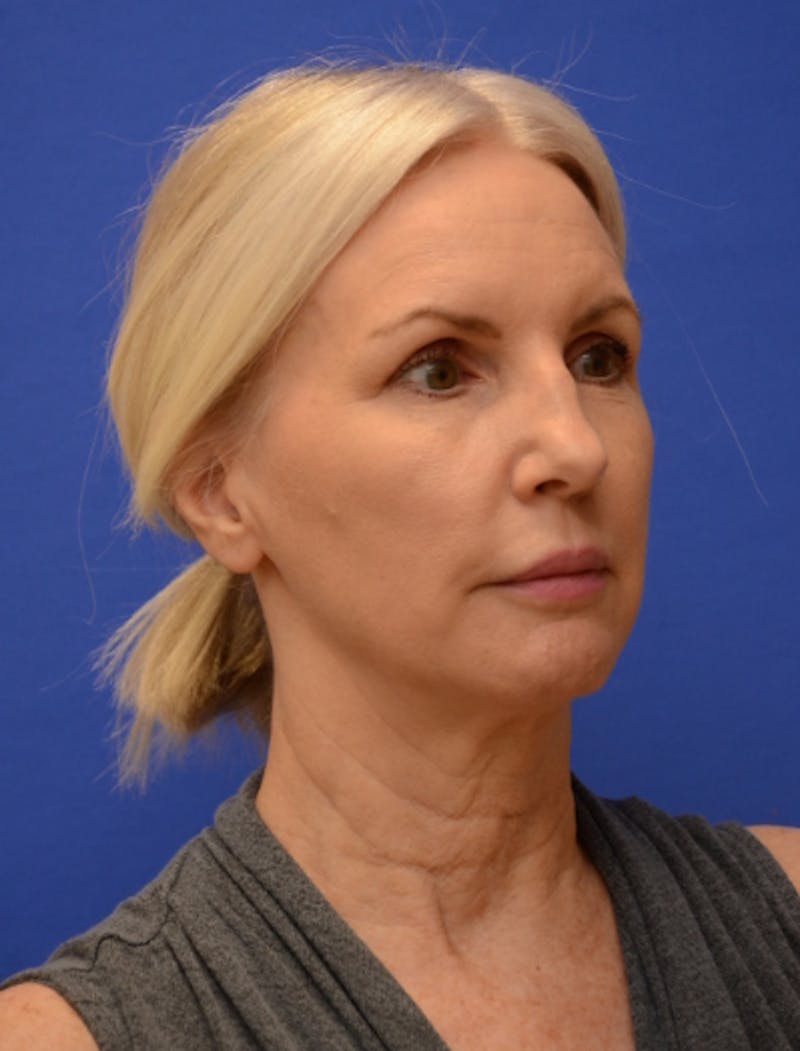Neck Liposuction Before & After Gallery - Patient 418344 - Image 7