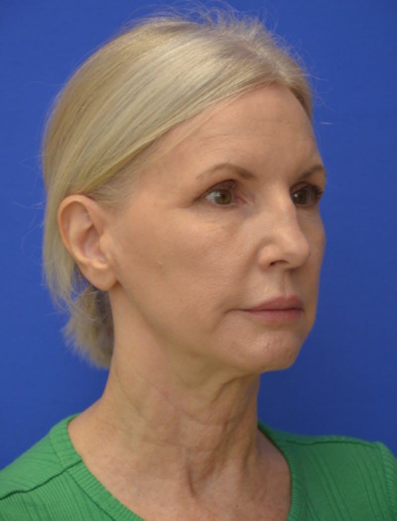 Neck Liposuction Before & After Gallery - Patient 418344 - Image 8
