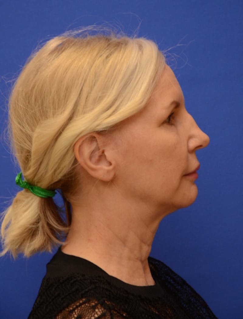 Neck Liposuction Before & After Gallery - Patient 418344 - Image 9