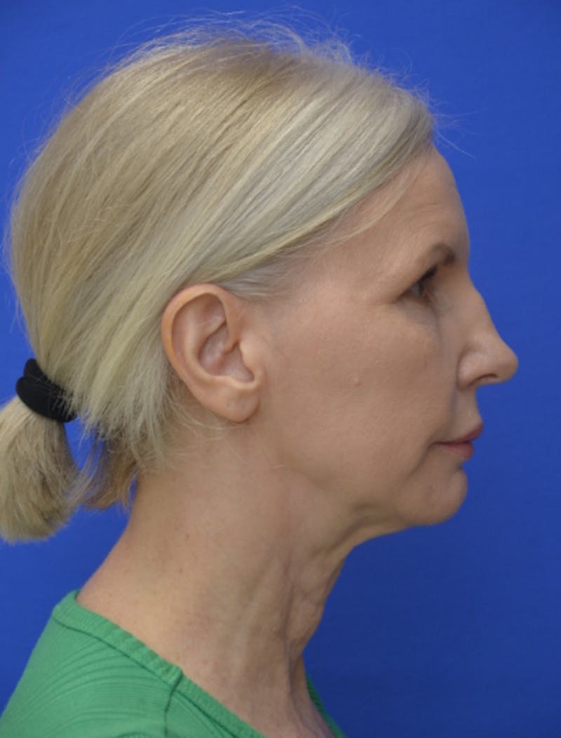 Neck Liposuction Before & After Gallery - Patient 418344 - Image 10