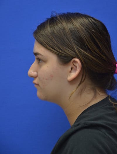 Neck Liposuction Before & After Gallery - Patient 185841 - Image 1