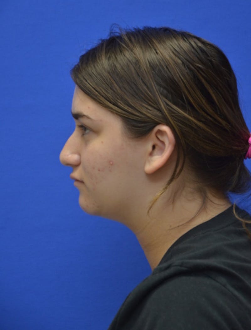 Neck Liposuction Before & After Gallery - Patient 185841 - Image 1