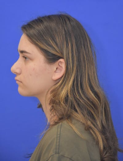 Neck Liposuction Before & After Gallery - Patient 185841 - Image 2