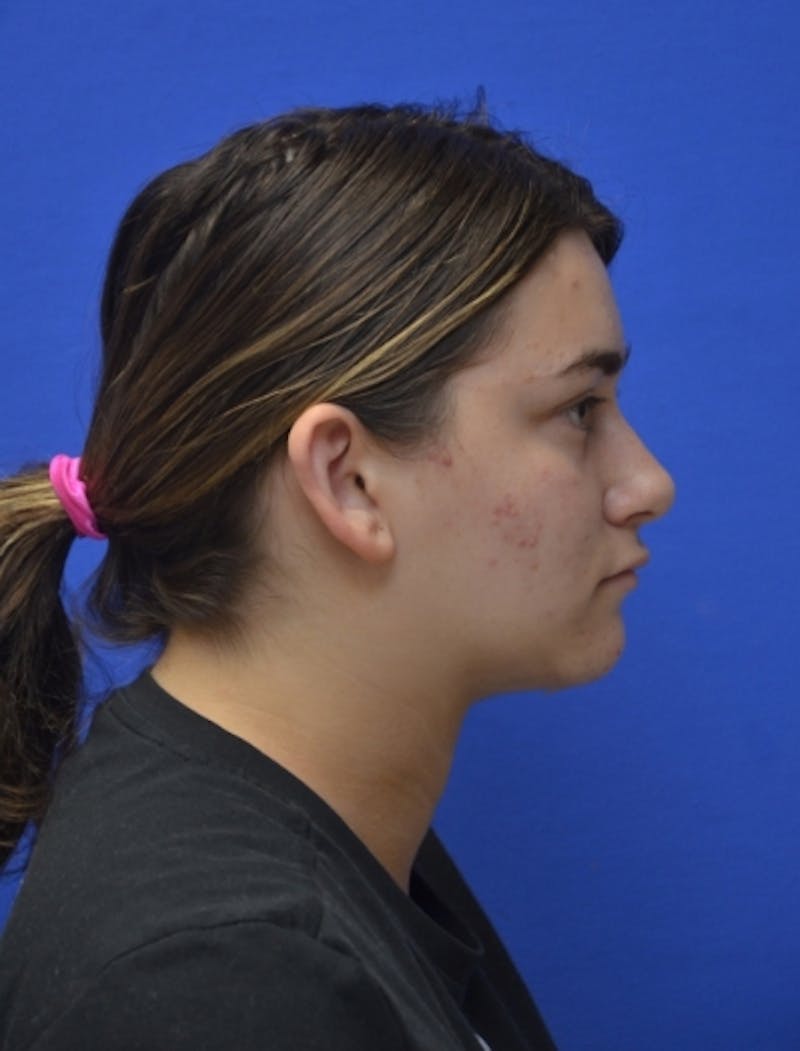 Neck Liposuction Before & After Gallery - Patient 185841 - Image 7