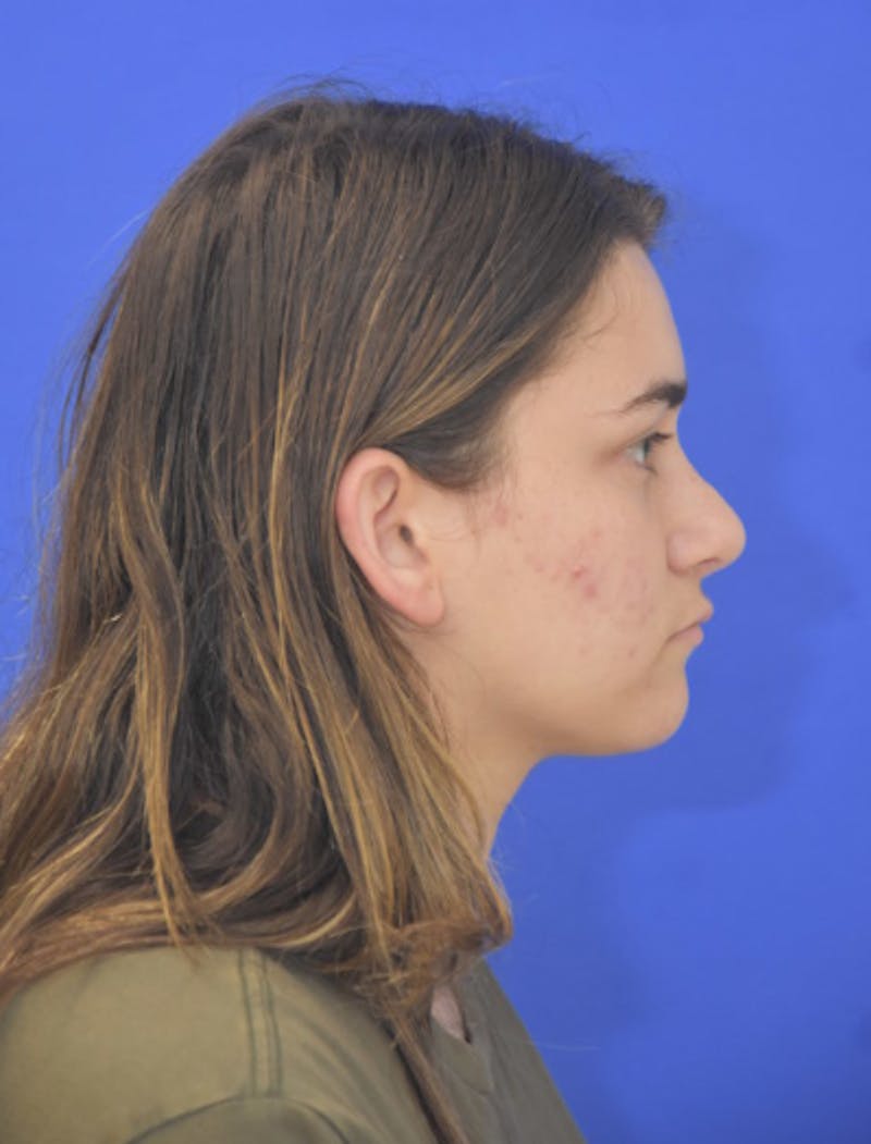 Neck Liposuction Before & After Gallery - Patient 185841 - Image 8