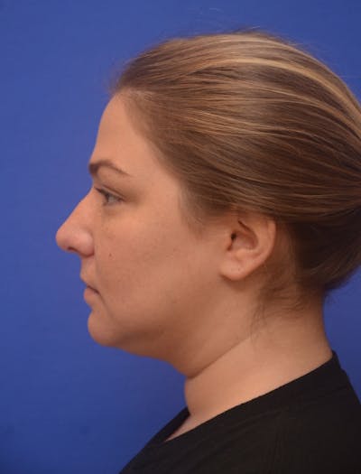 Neck Liposuction Before & After Gallery - Patient 162855 - Image 1