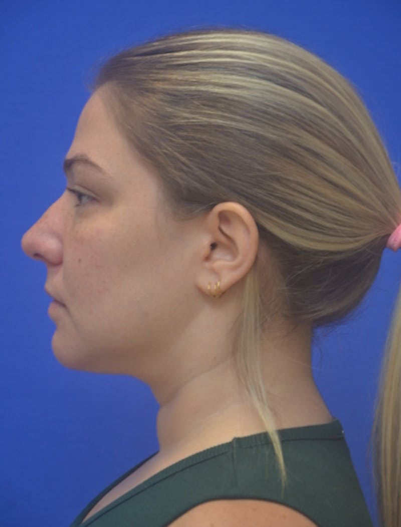 Neck Liposuction Before & After Gallery - Patient 162855 - Image 2