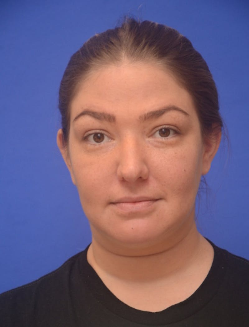 Neck Liposuction Before & After Gallery - Patient 162855 - Image 3
