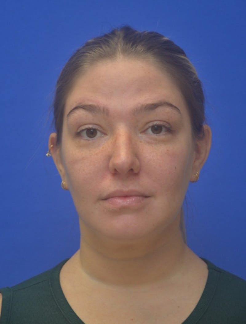 Neck Liposuction Before & After Gallery - Patient 162855 - Image 4