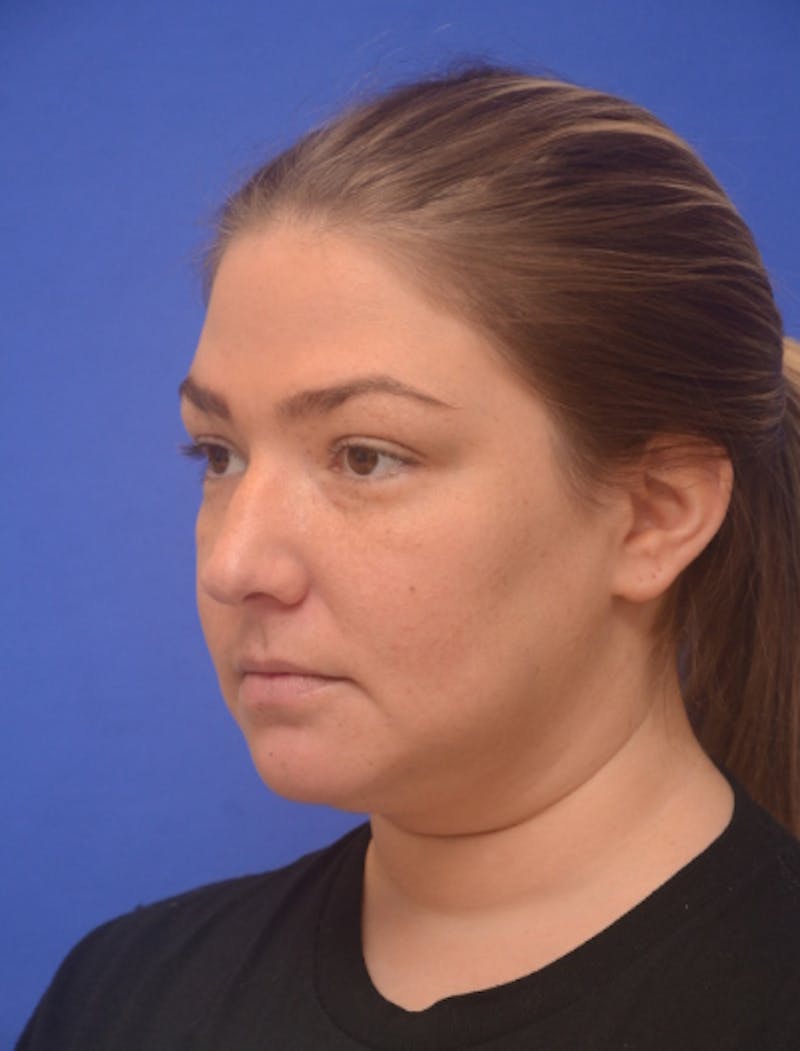 Neck Liposuction Before & After Gallery - Patient 162855 - Image 5