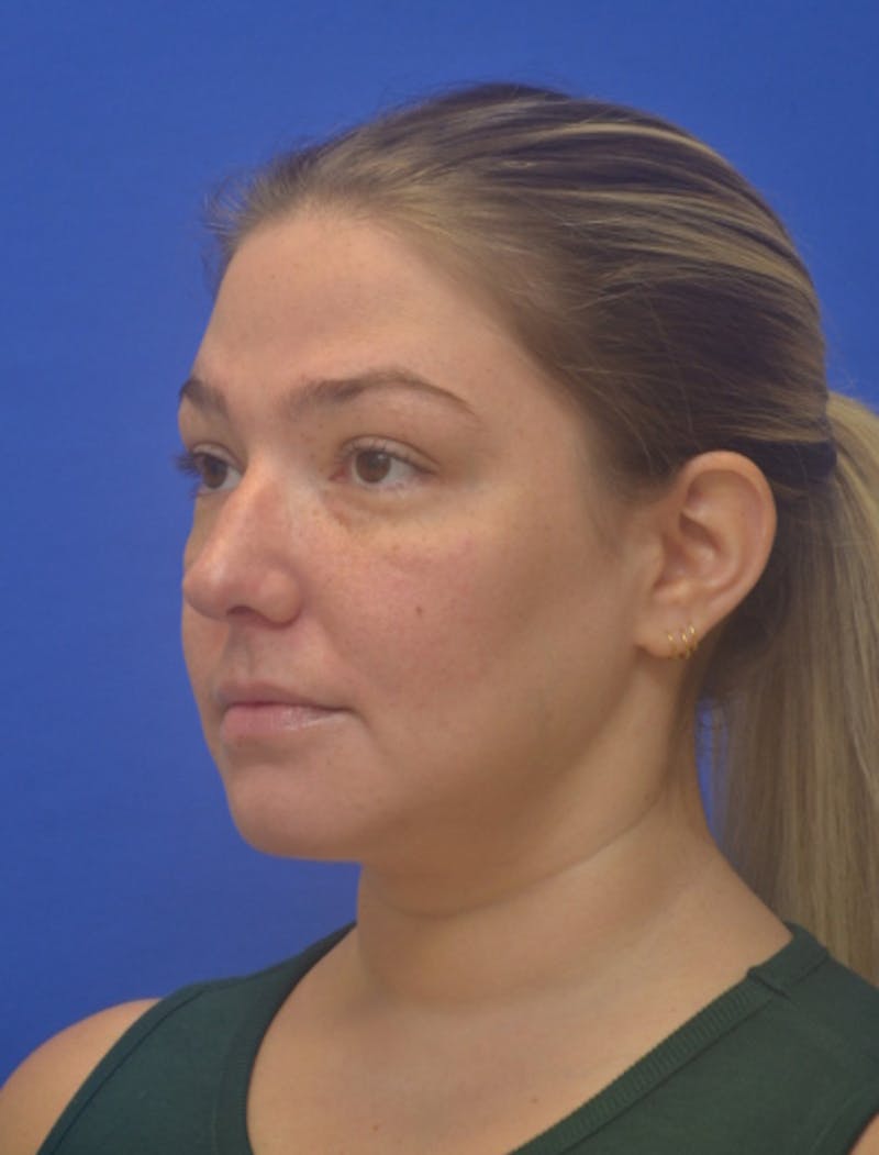 Neck Liposuction Before & After Gallery - Patient 162855 - Image 6