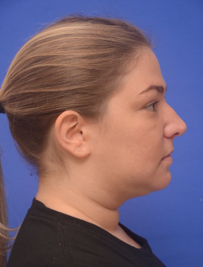 Neck Liposuction Before & After Gallery - Patient 162855 - Image 7