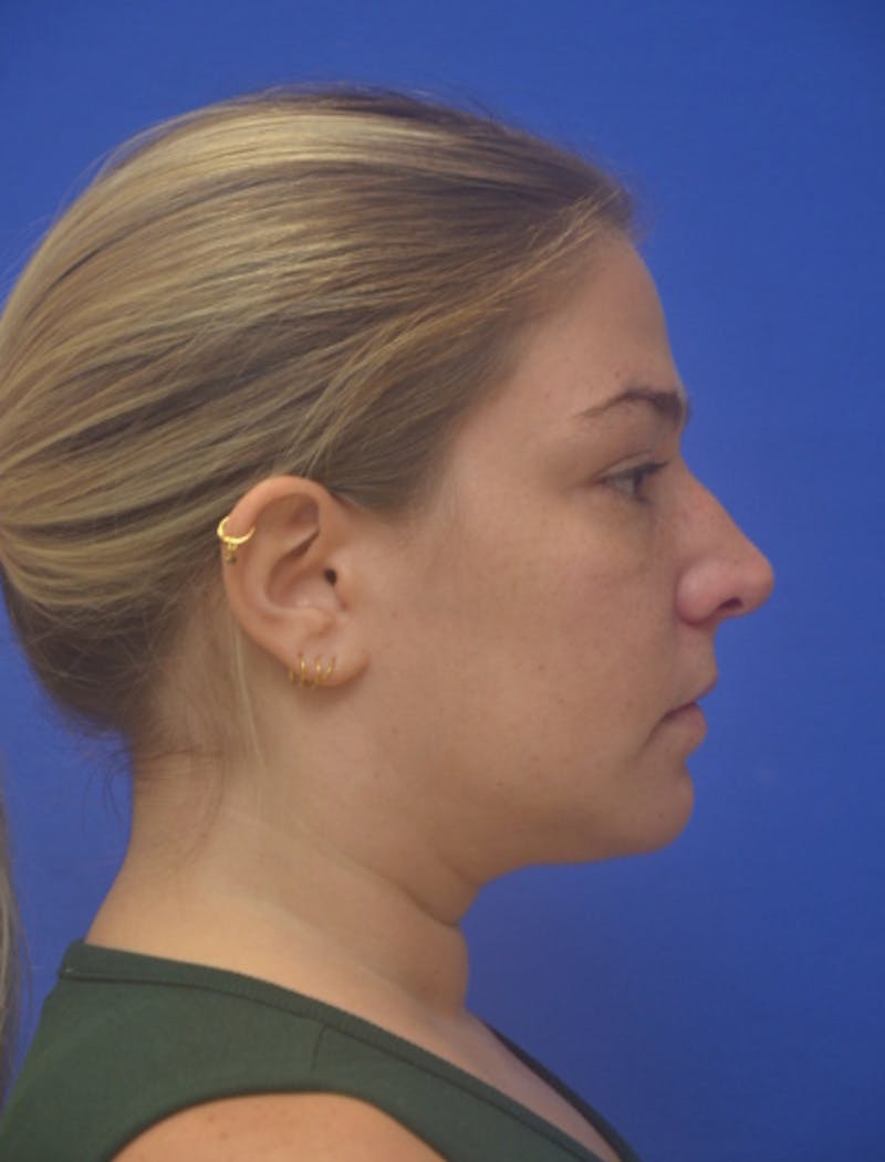 Neck Liposuction Before & After Gallery - Patient 162855 - Image 8