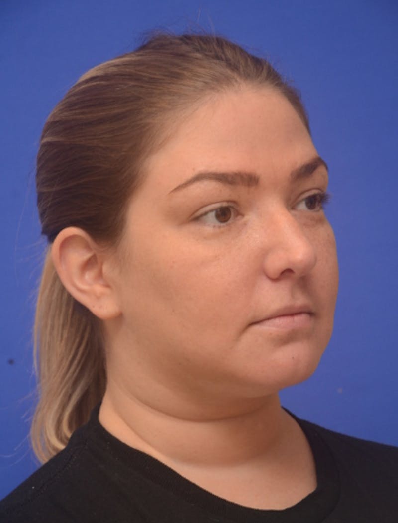 Neck Liposuction Before & After Gallery - Patient 162855 - Image 9