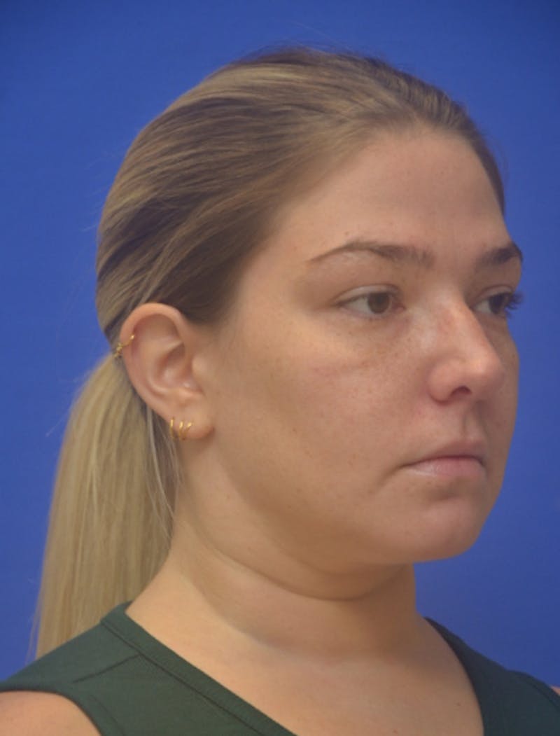 Neck Liposuction Before & After Gallery - Patient 162855 - Image 10