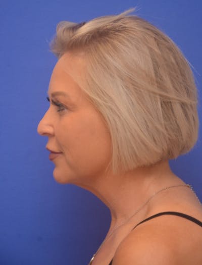 Neck Liposuction Before & After Gallery - Patient 214085 - Image 1