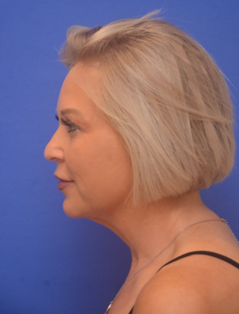Neck Liposuction Before & After Gallery - Patient 214085 - Image 1