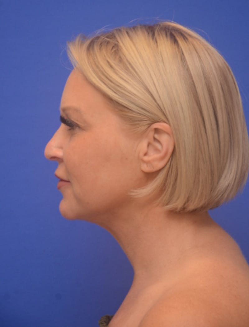 Neck Liposuction Before & After Gallery - Patient 214085 - Image 2