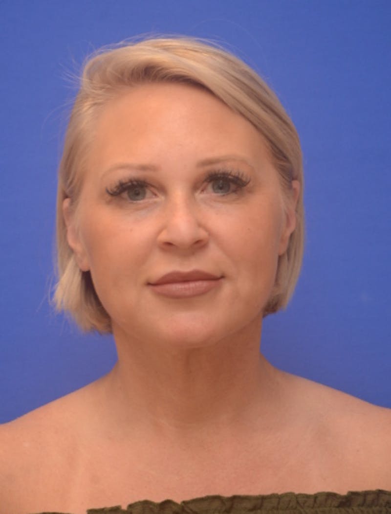 Neck Liposuction Before & After Gallery - Patient 214085 - Image 4